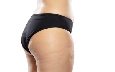 Hoe ontstaat cellulite en wat kun je er aan doen?